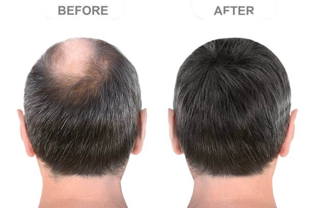 Men's hair transformation before and after using Halo Grow